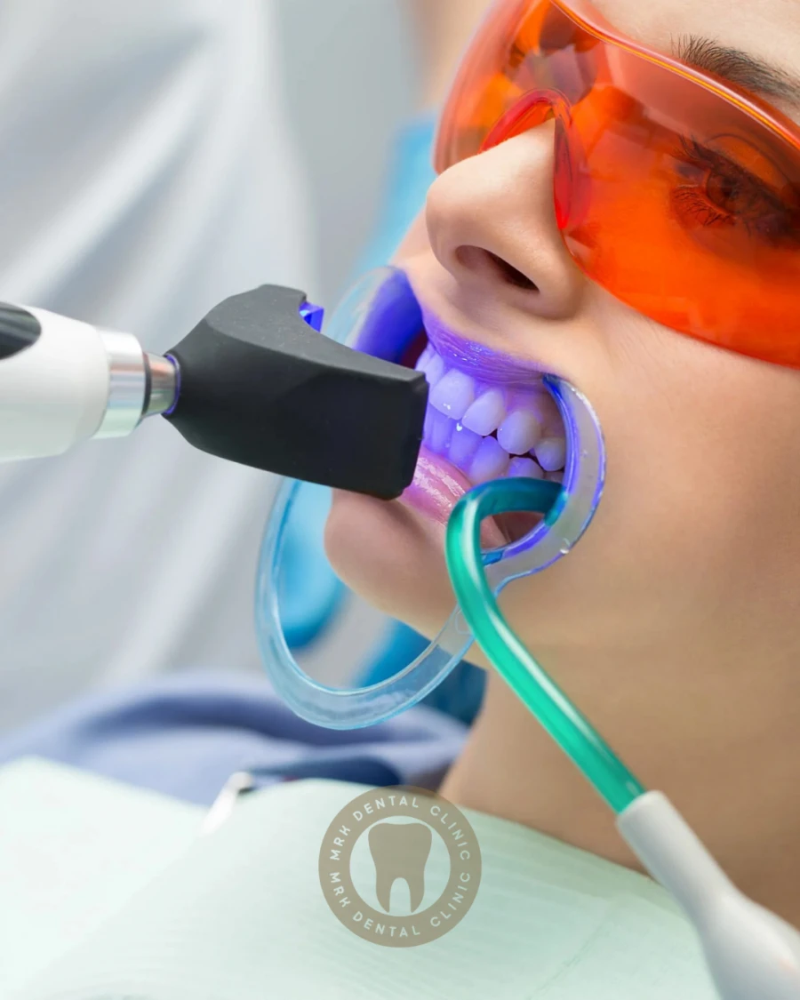 Laser Teeth Whitening (bleaching)