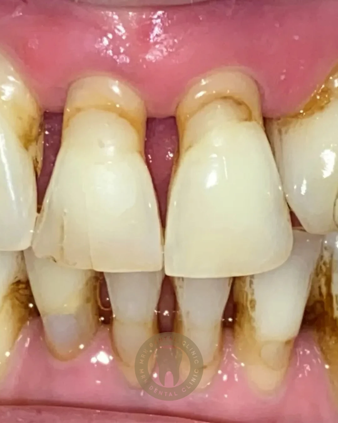 Treatment of Periodontal Disease