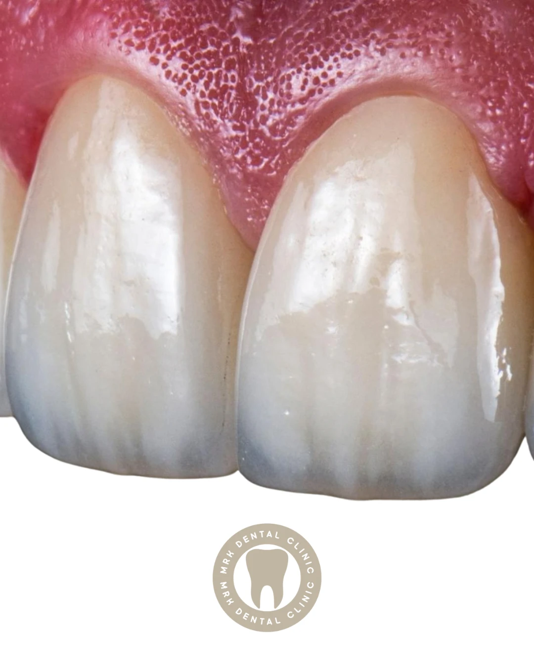 E-max Veneers