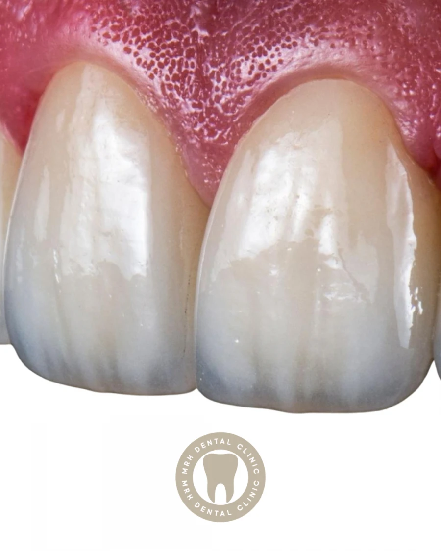 E-max Veneers